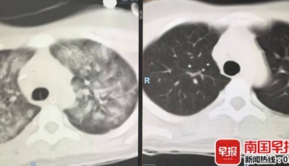 贵港一女子误服农药抢救多日未好转，家属刷手机看新闻迎转机